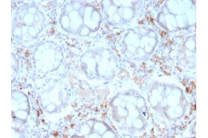 Formalin-fixed, paraffin-embedded human Colon Carcinoma stained with CD209 Mouse Monoclonal Antibody (rC209/1781). (Rekombinanter DC-SIGN/CD209 Antikörper)