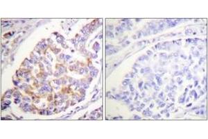 Immunohistochemistry analysis of paraffin-embedded human breast carcinoma, using ADD1 (Phospho-Ser726) Antibody. (alpha Adducin Antikörper  (pSer726))