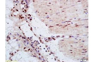 Formalin-fixed and paraffin embedded human gastric carcinoma labeled with Anti-YAP1 Polyclonal Antibody, Unconjugated (ABIN701485) at 1:200 followed by conjugation to the secondary antibody and DAB staining.