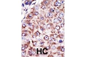 Formalin-fixed and paraffin-embedded human cancer tissue reacted with the primary antibody, which was peroxidase-conjugated to the secondary antibody, followed by DAB staining. (FDFT1 Antikörper  (N-Term))