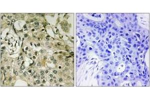 Immunohistochemistry analysis of paraffin-embedded human breast carcinoma tissue, using DTYMK Antibody.
