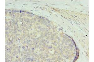 Immunohistochemistry of paraffin-embedded human gastric cancer using ABIN7166707 at dilution of 1:100 (GTPBP6 Antikörper  (AA 146-295))