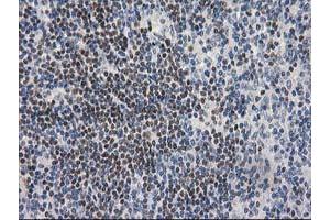 Immunohistochemical staining of paraffin-embedded Human lymphoma tissue using anti-ARFGAP1 mouse monoclonal antibody. (ARFGAP1 Antikörper)