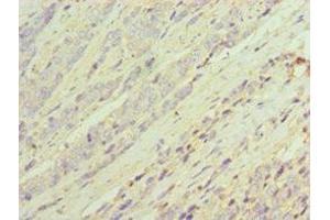 Immunohistochemistry of paraffin-embedded human colon cancer using ABIN7143694 at dilution of 1:100 (AKR1C3 Antikörper  (AA 1-323))