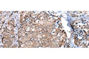 Immunohistochemistry of paraffin-embedded Human breast cancer tissue using WFDC5 Polyclonal Antibody at dilution of 1:60(x200) (WFDC5 Antikörper)