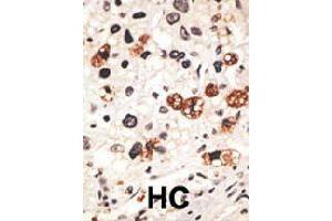 Formalin-fixed and paraffin-embedded human hepatocellular carcinoma tissue reacted with GJB3 polyclonal antibody  , which was peroxidase-conjugated to the secondary antibody, followed by DAB staining. (Connexin 31 Antikörper  (C-Term))