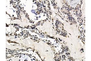 ABIN7096386 and ABIN7100450 at 1/100 staining human ovarian cancer by IHC-P.