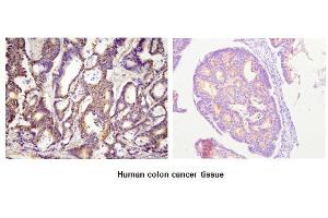 Paraffin embedded sections of human colon canitrocelluloseer tissue were initrocelluloseubated with anti-human ACOT11 (1:100) for 2 hours at room temperature. (ACOT11 Antikörper  (AA 19-250))