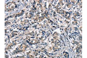 The image on the left is immunohistochemistry of paraffin-embedded Human breast cancer tissue using ABIN7189845(APOA1BP Antibody) at dilution 1/15, on the right is treated with synthetic peptide. (APOA1BP Antikörper)