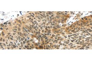 Immunohistochemistry of paraffin-embedded Human esophagus cancer tissue using TTBK2 Polyclonal Antibody at dilution 1:45 (TTBK2 Antikörper)