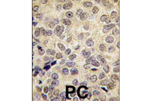 Formalin-fixed and paraffin-embedded human prostate carcinoma tissue reacted with DNMT3B polyclonal antibody  , which was peroxidase-conjugated to the secondary antibody, followed by DAB staining. (DNMT3B Antikörper  (Internal Region))