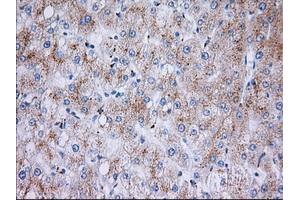 Immunohistochemical staining of paraffin-embedded Carcinoma of Human liver tissue using anti-RAB17 mouse monoclonal antibody. (RAB17 Antikörper)