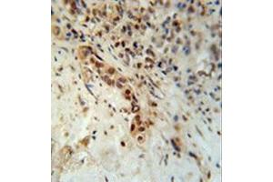 Formalin fixed, paraffin embedded human lung carcinoma stained with Artemis Antibody (N-term) followed by peroxidase conjugation of the secondary antibody and DAB staining.