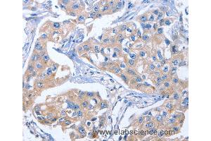 Immunohistochemistry of Human colon cancer using IBSP Polyclonal Antibody at dilution of 1:50 (IBSP Antikörper)