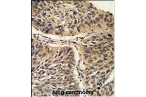 Formalin-fixed and paraffin-embedded human lung carcinoma reacted with CCT3 Antibody (C-term), which was peroxidase-conjugated to the secondary antibody, followed by DAB staining. (CCT3 Antikörper  (C-Term))