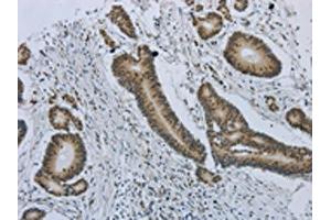 The image on the left is immunohistochemistry of paraffin-embedded Human colorectal cancer tissue using ABIN7191486(MMP24 Antibody) at dilution 1/25, on the right is treated with synthetic peptide. (MMP24 Antikörper)
