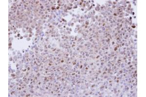IHC-P Image Immunohistochemical analysis of paraffin-embedded CL1-5 xenograft, using proteasome alpha 7, antibody at 1:100 dilution. (PSMA7 Antikörper  (Center))