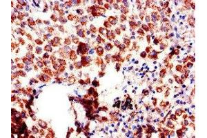 Immunohistochemistry of paraffin-embedded human lung cancer using ABIN7144520 at dilution of 1:100 (AQP6 Antikörper  (AA 1-30))