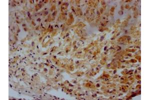 IHC image of ABIN7147174 diluted at 1:500 and staining in paraffin-embedded human glioma tissue performed on a Leica BondTM system. (CD63 Antikörper  (AA 103-203))