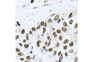 Immunohistochemical analysis of METTL3 staining in human lung cancer formalin fixed paraffin embedded tissue section. (METTL3 Antikörper)