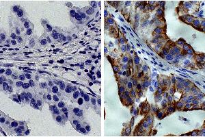 Paraffin embedded human gastric cancer tissue was stained with Mouse IgG2a-HRP isotype control followed by DAB and hematoxylin.