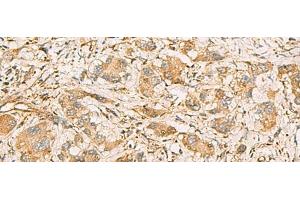 Immunohistochemistry of paraffin-embedded Human liver cancer tissue using MRPS35 Polyclonal Antibody at dilution of 1:60(x200) (MRPS35 Antikörper)