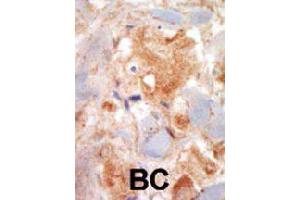 Formalin-fixed and paraffin-embedded human cancer tissue reacted with KIT polyclonal antibody  , which was peroxidase-conjugated to the secondary antibody, followed by DAB staining. (KIT Antikörper  (N-Term))