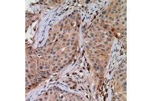 Immunohistochemical analysis of UBE2G1 staining in human breast cancer formalin fixed paraffin embedded tissue section.