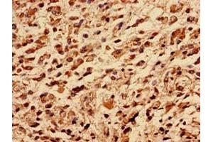 Immunocytochemistry analysis of human glioma using ABIN7142719 at dilution of 1:100 (50S Ribosomal Protein L16 (RplP) (AA 1-317) Antikörper)