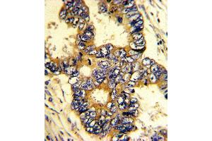 Formalin-fixed and paraffin-embedded human colon carcinoma with EPN3 Antibody (N-term), which was peroxidase-conjugated to the secondary antibody, followed by DAB staining. (EPN3 Antikörper  (N-Term))