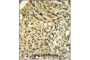 FKBP14 Antibody (N-term) (ABIN390491 and ABIN2840850) IHC analysis in formalin fixed and paraffin embedded human Lung carcinoma followed by peroxidase conjugation of the secondary antibody and DAB staining.