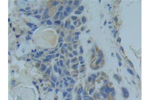 Detection of TNFR1 in Human Lung cancer Tissue using Polyclonal Antibody to Tumor Necrosis Factor Receptor 1 (TNFR1) (TNFRSF1A Antikörper  (AA 248-428))