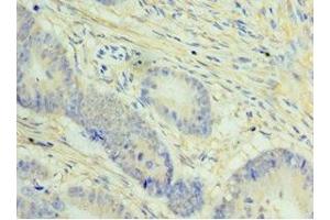 Immunohistochemistry of paraffin-embedded human colon cancer using ABIN7148434 at dilution of 1:100 (NCAPH Antikörper  (AA 1-250))