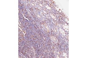 Immunohistochemical analysis of C on paraffin-embedded Human colon carcinoma tissue. (Glucuronidase beta Antikörper  (AA 335-362))