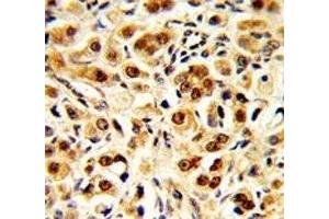 IHC analysis of FFPE human prostate carcinoma with GAPDH antibody
