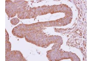 IHC-P Image Immunohistochemical analysis of paraffin-embedded human colon carcinoma, using ARHGAP4, antibody at 1:500 dilution. (ARHGAP4 Antikörper  (N-Term))