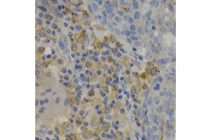 Immunohistochemistry of paraffin-embedded human lung cancer using PAK1 Antibody. (PAK1 Antikörper)