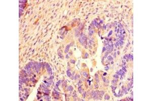 Immunohistochemistry of paraffin-embedded human ovarian cancer using ABIN7168711 at dilution of 1:100 (SCG2 Antikörper  (AA 31-617))