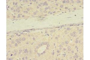 Immunohistochemistry of paraffin-embedded human liver cancer using ABIN7165968 at dilution of 1:100 (PPME1 Antikörper  (AA 201-386))