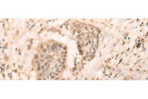 Immunohistochemistry of paraffin-embedded Human esophagus cancer tissue using ELP4 Polyclonal Antibody at dilution of 1:25(x200)