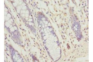 Immunohistochemistry of paraffin-embedded human colon cancer using SEC61G Antibody at a dilution of 1:100 (SEC61G Antikörper  (AA 1-32))