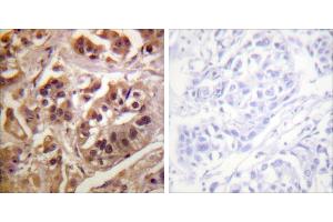 Peptide - +Immunohistochemistry analysis of paraffin-embedded human breast carcinoma tissue using GRF-1 antibody. (GRLF1 Antikörper)