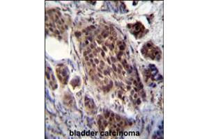 FRAT2 Antibody immunohistochemistry analysis in formalin fixed and paraffin embedded human bladder carcinoma followed by peroxidase conjugation of the secondary antibody and DAB staining. (FRAT2 Antikörper  (C-Term))