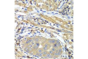 Immunohistochemistry of paraffin-embedded human gastric cancer using PICK1 antibody at dilution of 1:100 (x40 lens). (PICK1 Antikörper)