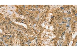 Immunohistochemistry of paraffin-embedded Human thyroid cancer using PSMC1 Polyclonal Antibody at dilution of 1:40 (PSMC1 Antikörper)