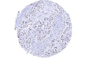 Distinct nucleolar immunostaining in the nucleoli of an esophageal squamous cell carcinoma (Rekombinanter Nucleolin Antikörper)