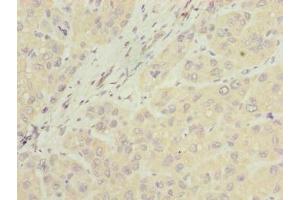 Immunohistochemistry of paraffin-embedded human liver cancer using ABIN7157067 at dilution of 1:100 (NUBPL Antikörper  (AA 39-319))