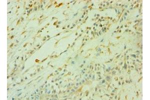 Immunohistochemistry of paraffin-embedded human breast cancer using ABIN7160470 at dilution of 1:100 (CD33 Antikörper  (AA 49-259))