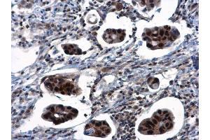 IHC-P Image TSPYL1 antibody detects TSPYL1 protein at nucleus in human breast cancer by immunohistochemical analysis. (TSPYL1 Antikörper)