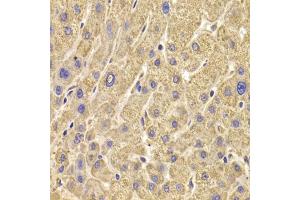 Immunohistochemistry of paraffin-embedded human liver damage using PEX5 antibody (ABIN6133015, ABIN6145469, ABIN6145471 and ABIN6221464) at dilution of 1:100 (40x lens). (PEX5 Antikörper  (AA 1-260))
